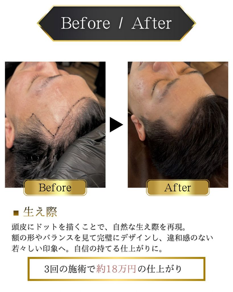 Before/After 生え際