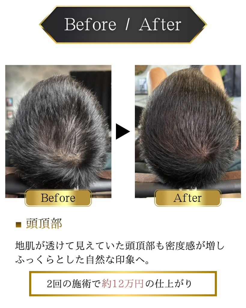 Before/After 頭頂部